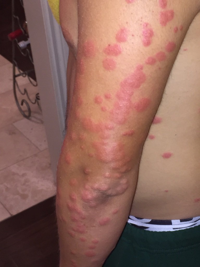 Bed bug bites