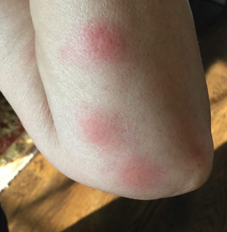 bed bg bites on skin Etobicoke